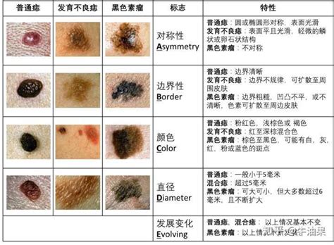 臉上的痣|痣是什麼？會變成黑色素瘤？7種一定要除的痣